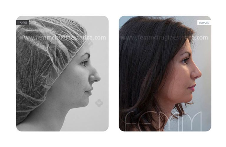 rinoplastia-caso-clinico-foto-01-a