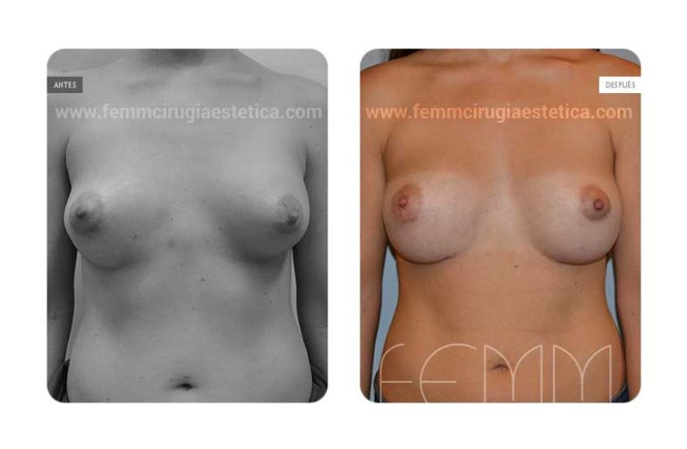 sustitucion-de-implantes-caso-clinico-foto-05-a
