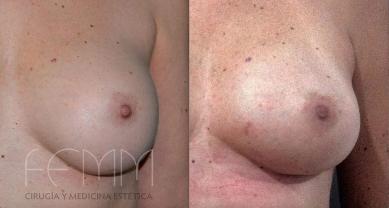 comparativa-protesis-versus-lipofilling
