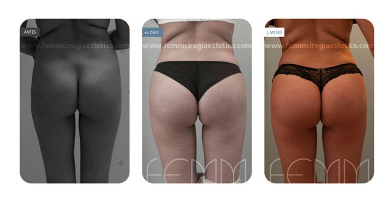 Fotografías antes y después de un aumento de glúteos con prótesis