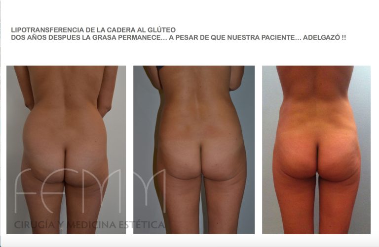 Lipofilling glúteo, con grasa extraída de otras zonas corporales