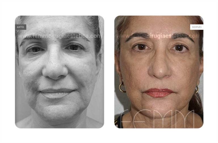 Fotografías antes y después de un mini lifting o lifting de incisión corta