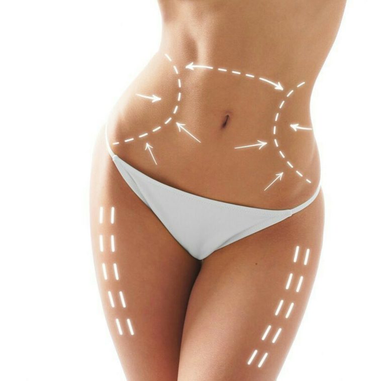 Zonas más típicas para tratar con liposucción