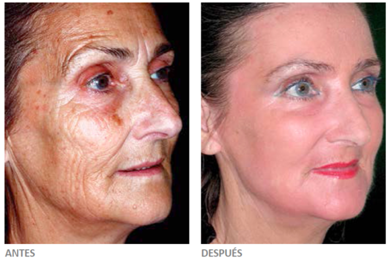Fotografías antes y después tras un peeling profundo. Cortesía de Sellaesthetics.