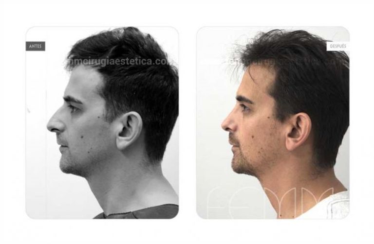 perfiloplastia