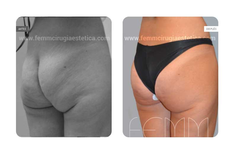 Aumento de glúteos con grasa propia · Caso 7 Foto 1