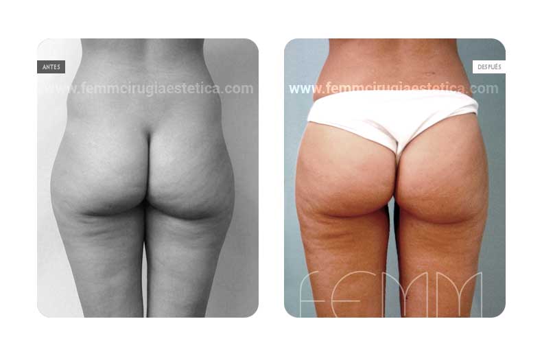 Aumento de glúteos con grasa propia · Caso 6 Foto 1