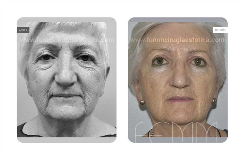 Blefaroplastia y Lipofilling de párpados · Caso 10 Foto 1