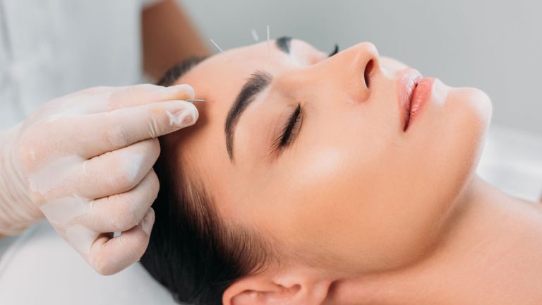 Cara de mujer recibiendo tratamiento de acupuntura estética