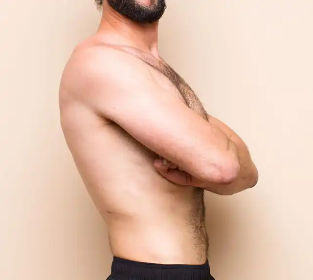 cirugia-corporal-post-obesidad-2