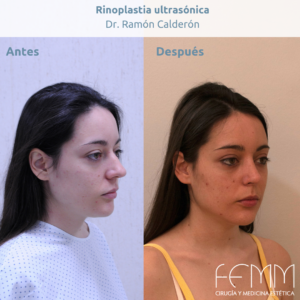 Fotografías antes y después de una rinoplastia ultrasónica realizada por el dr. Ramón Calderón