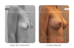 aumento de senos con implantes carlos gullón cabrero Foto oblicua derecha antes y después de un aumento de pecho con prótesis