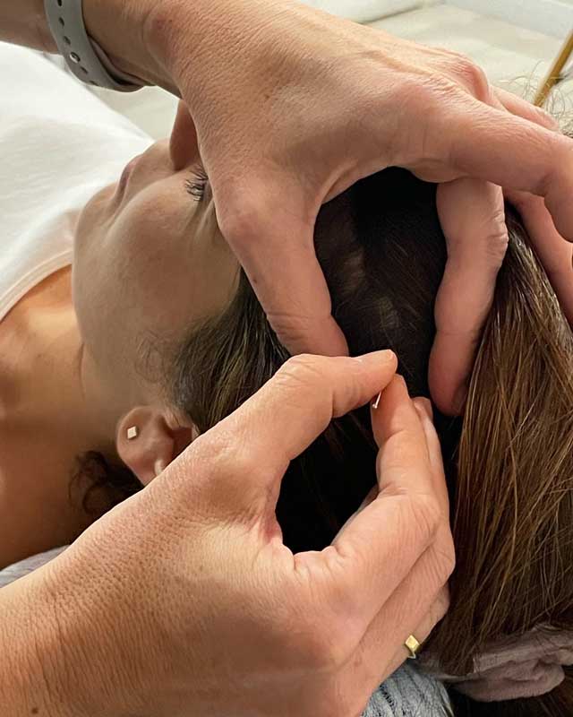 Detalle de la Dra. Gómez aplicando acupuntura a una paciente en la cabeza en la clínica FEMM