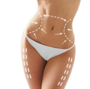 Zonas más típicas para tratar con liposucción