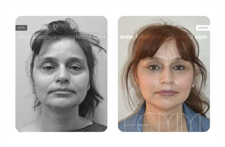 Lifting facial · Caso 3 Foto 1